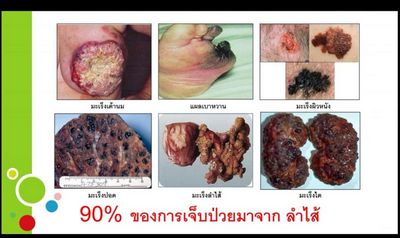 การดูแลหัวใจของคุณอาจช่วยให้ไตของคุณดีขึ้น ใน     วารสาร American Heart